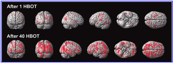 hbot phase 1 study hbot for blast-induced TBI