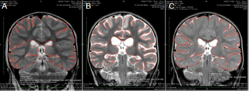 MRI Scan Drowning