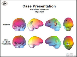 hbot and spect imaging