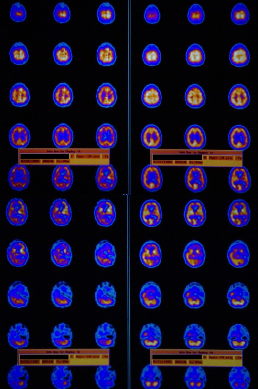 TBI scan 1