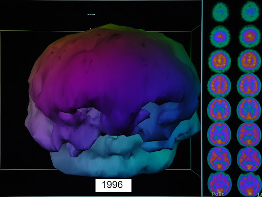 Brain scan alcohol