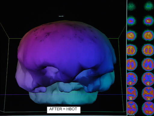 Alcohol brain scan